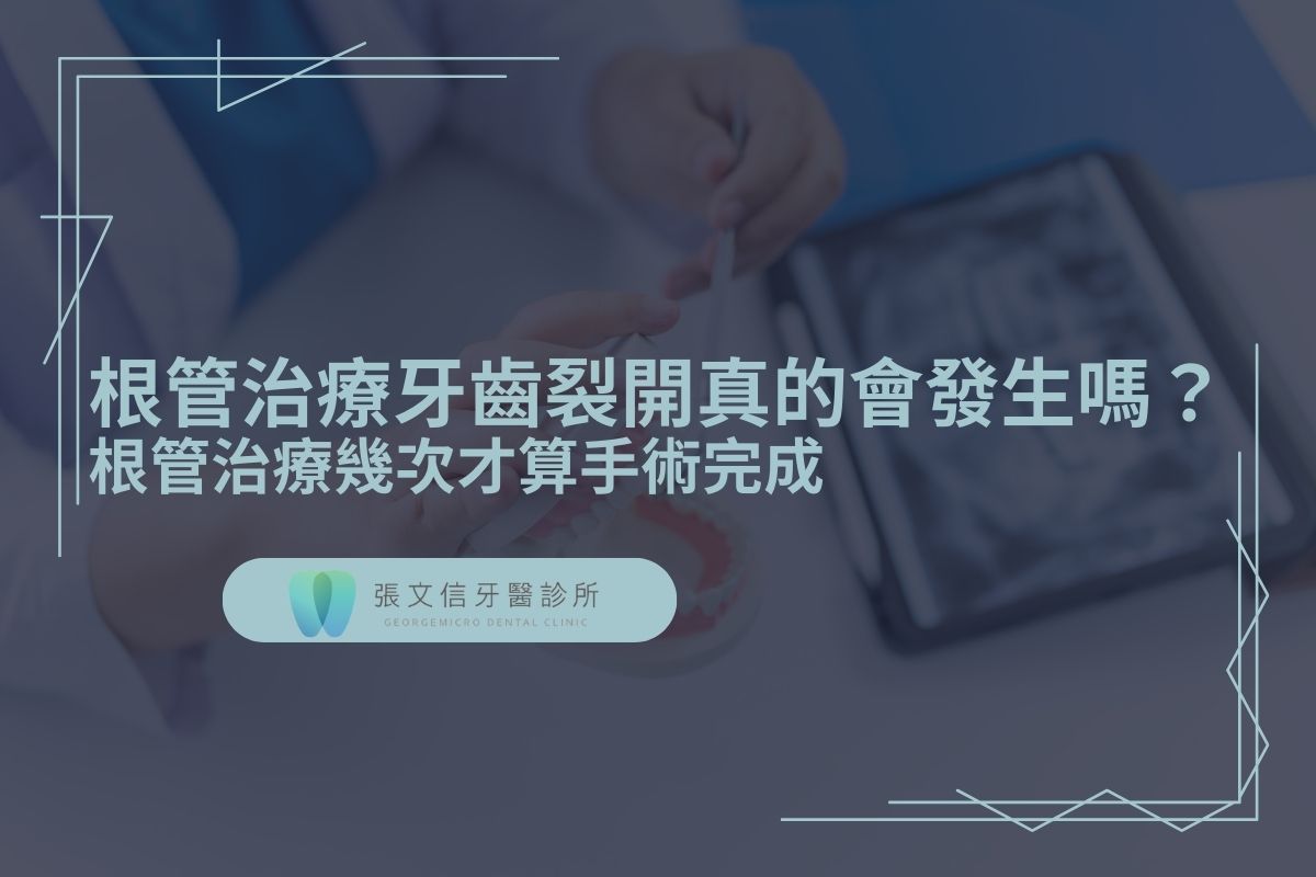 Read more about the article 根管治療牙齒裂開真的會發生嗎？根管治療幾次才算手術完成